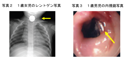喉の画像
